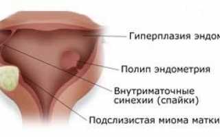 Гистероскопия матки: что это такое, как она проводится