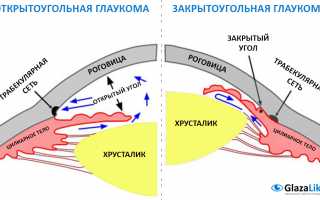 Открытоугольная глаукома 1 и 2 степени: причины, симптомы, лечение и профилактика